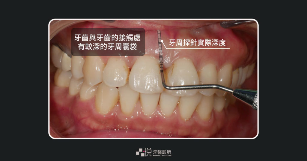 牙周病導致超過5mm的牙周囊袋