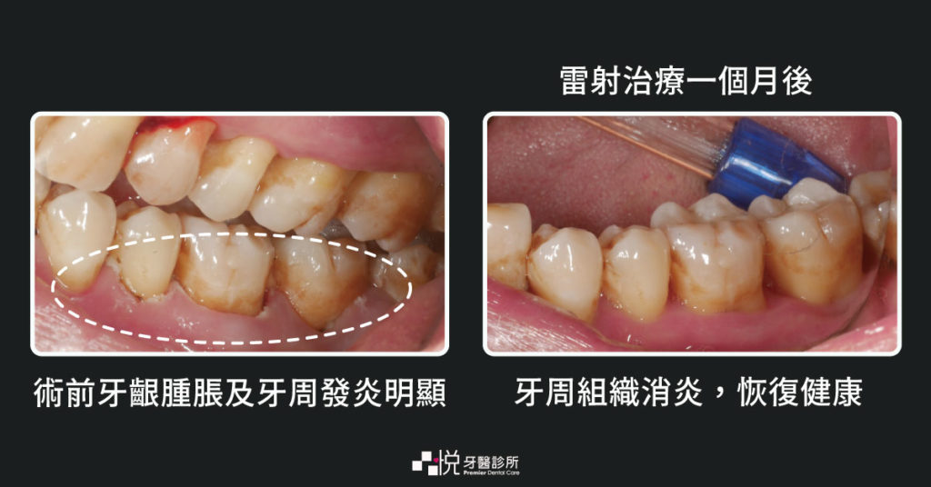 傳統雷射牙周治療讓牙齦消炎的照片